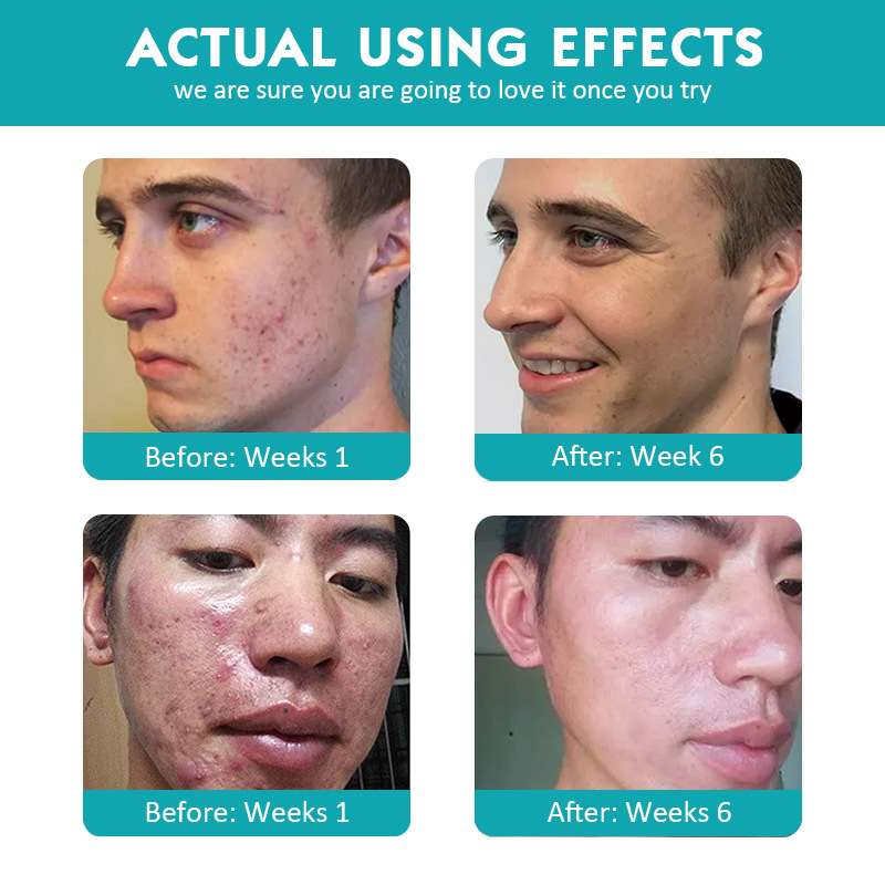 Proactiv 3 Step Acne Treatment for cross-border exclusive use The same high moisturizing acne acne treatment set