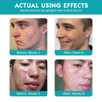 Proactiv 3 Step Acne Treatment for cross-border exclusive use The same high moisturizing acne acne treatment set