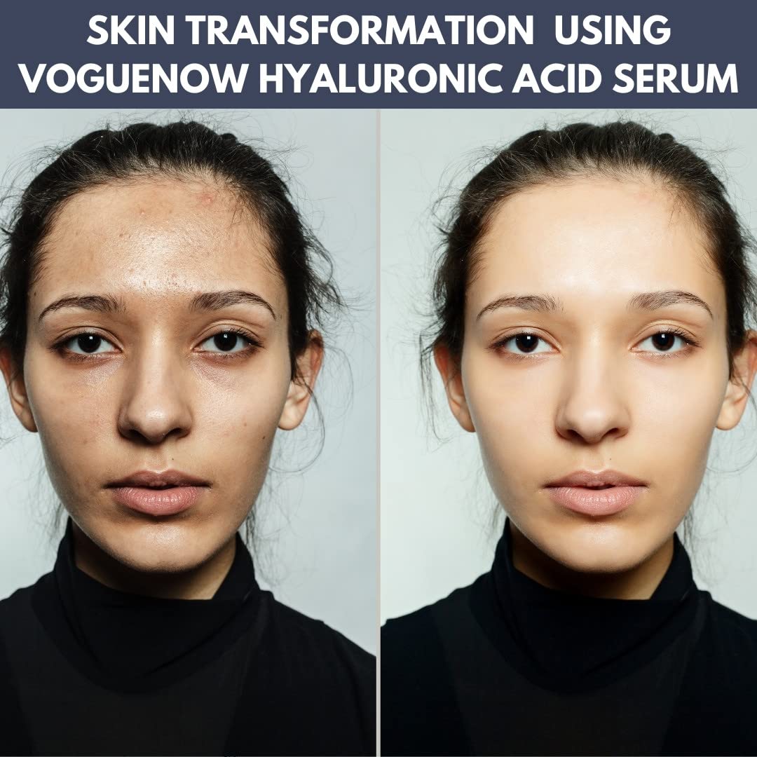 Hyaluronic Acid Serum Ampoules Pack (10pc) - Boosts Light Therapy Results - Anti Wrinkle and Anti Aging Serum - Moisturizing and Hydrating Facial Serum. Light therapy Hyaluronic Acid Serum