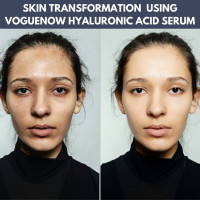 Hyaluronic Acid Serum Ampoules Pack (10pc) - Boosts Light Therapy Results - Anti Wrinkle and Anti Aging Serum - Moisturizing and Hydrating Facial Serum. Light therapy Hyaluronic Acid Serum