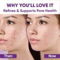 Azelaic Acid Acne Cream: Azelaic Acid For Face - Premium Azelaic Acid Cream - Face Skin and Beauty Care - Azelaic Acid Facial Cream, 1.01 Oz