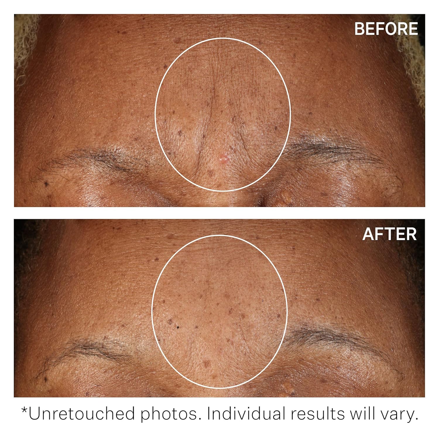 StriVectin SD Advanced Plus Intensive Moisturizer for Wrinkles and Stretchmarks, For Face and Body, Collagen Boosting with Peptides and Hyaluronic Acid 2 FL OZ (Pack of 1)