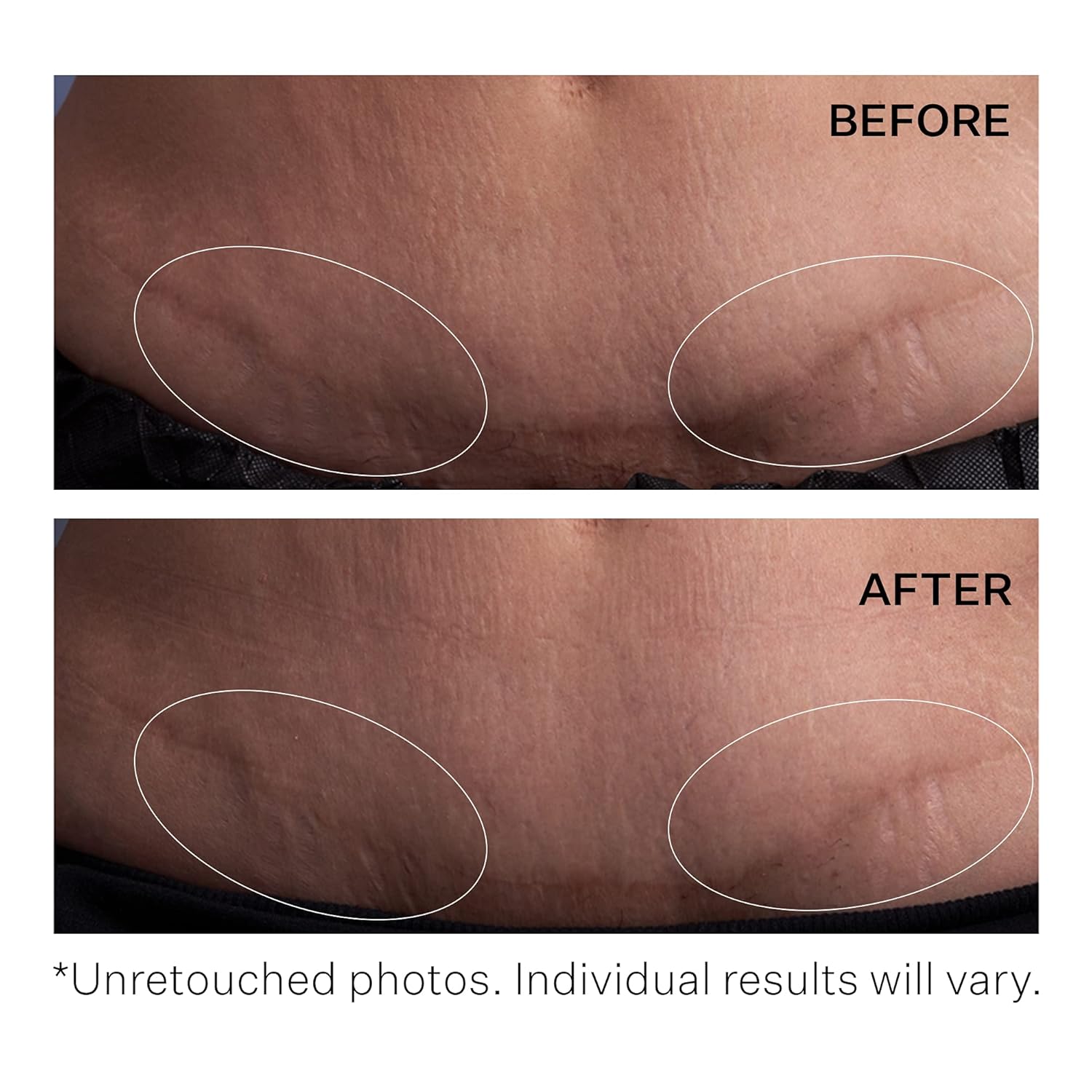 StriVectin SD Advanced Plus Intensive Moisturizer for Wrinkles and Stretchmarks, For Face and Body, Collagen Boosting with Peptides and Hyaluronic Acid 2 FL OZ (Pack of 1)