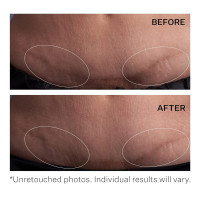 StriVectin SD Advanced Plus Intensive Moisturizer for Wrinkles and Stretchmarks, For Face and Body, Collagen Boosting with Peptides and Hyaluronic Acid 2 FL OZ (Pack of 1)