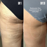 MAËLYS Cosmetics B-TIGHT Leave-On Cellulite Mask - Reduces The Appearance Of Cellulite - Visibly Tightens The Skin In The Butt Area 2 Pack