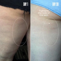 MAËLYS Cosmetics B-TIGHT Leave-On Cellulite Mask - Reduces The Appearance Of Cellulite - Visibly Tightens The Skin In The Butt Area 2 Pack