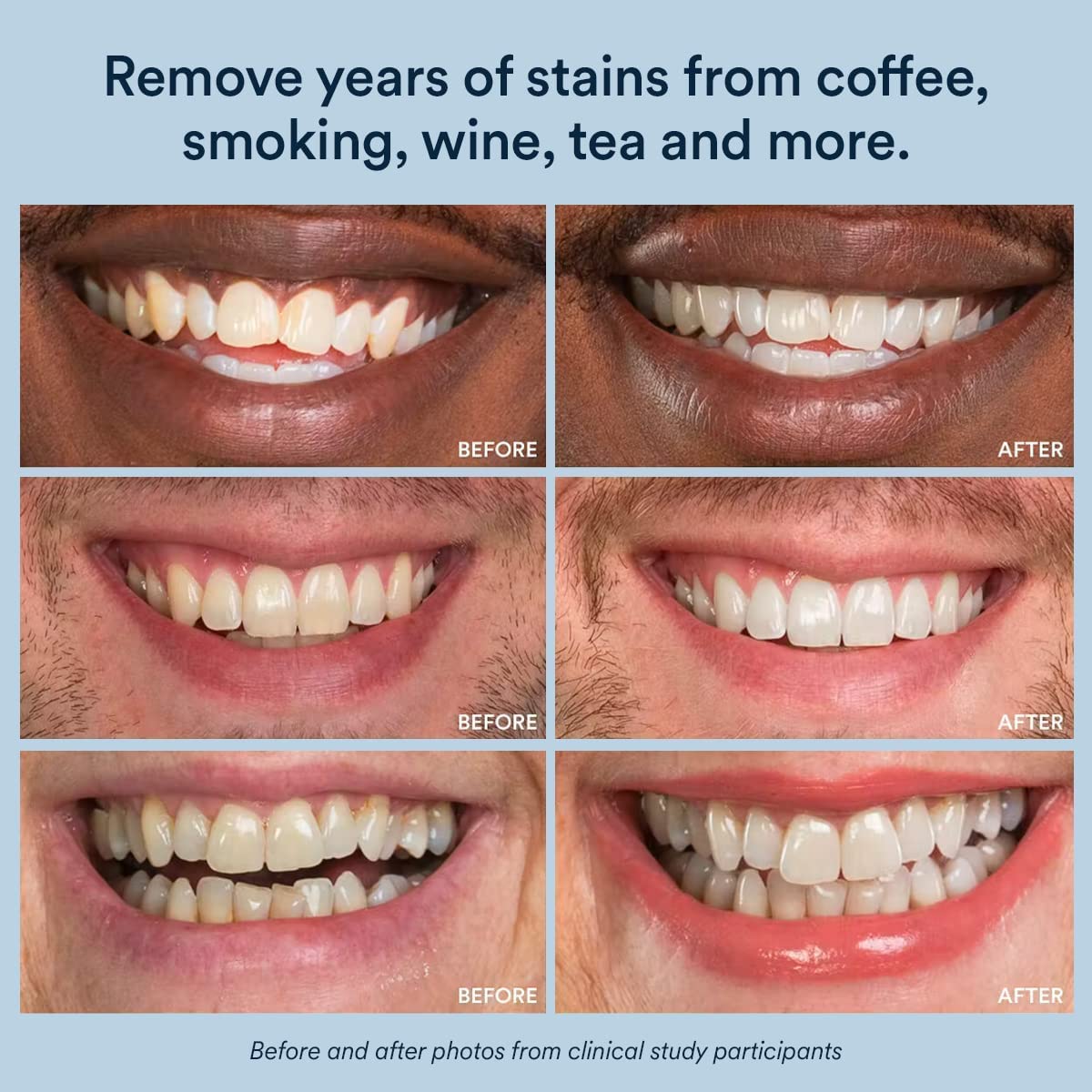 Auraglow Teeth Whitening Kit & 35% Teeth Whitening Gel Refill Pack